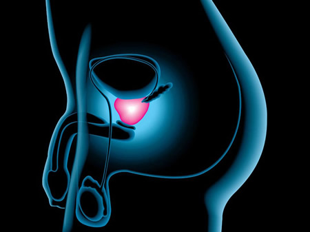 Cancer de próstata